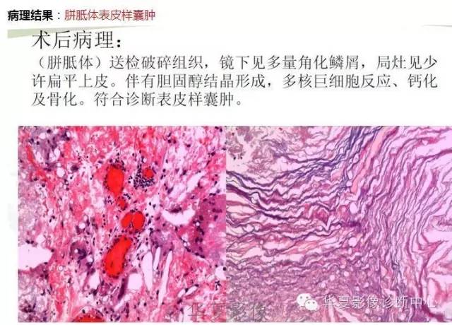 【病例】脑室内表皮样囊肿1例MR影像表现