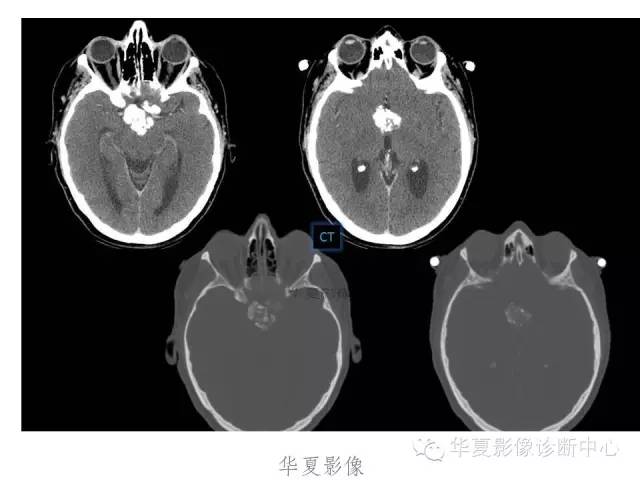 颅咽管瘤的影像学表现 颅咽管瘤的影像学表现