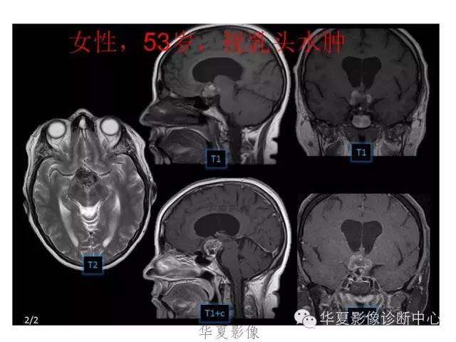 颅咽管瘤的影像学表现