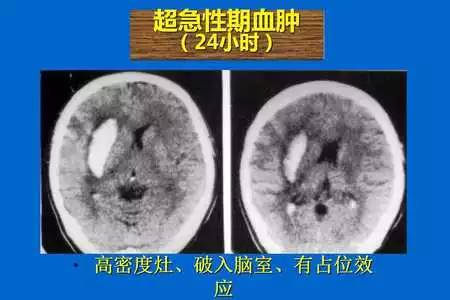 【PPT】脑出血的 CT/MRI