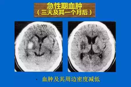 【PPT】脑出血的 CT/MRI