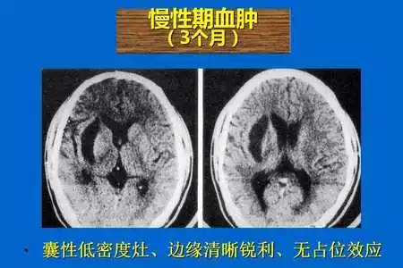 【PPT】脑出血的 CT/MRI