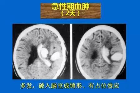 【PPT】脑出血的 CT/MRI