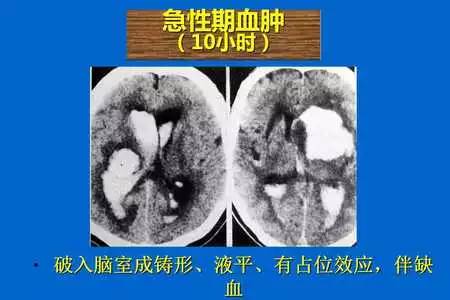 【PPT】脑出血的 CT/MRI