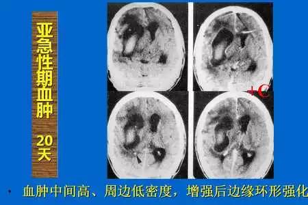 【PPT】脑出血的 CT/MRI