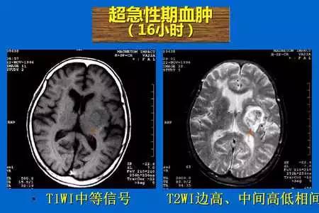 【PPT】脑出血的 CT/MRI