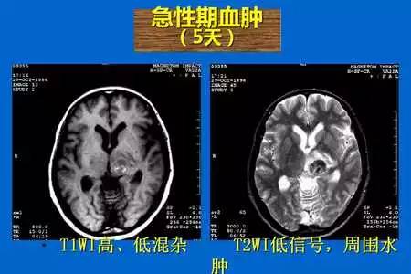 【PPT】脑出血的 CT/MRI