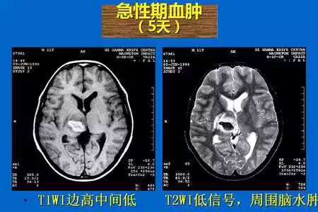 【PPT】脑出血的 CT/MRI