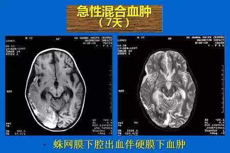 【PPT】脑出血的 CT/MRI