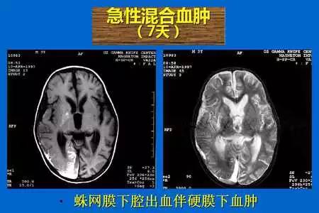 【PPT】脑出血的 CT/MRI