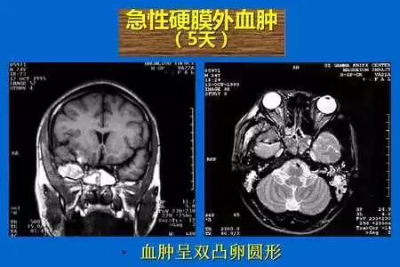【PPT】脑出血的 CT/MRI