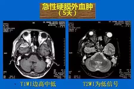 【PPT】脑出血的 CT/MRI