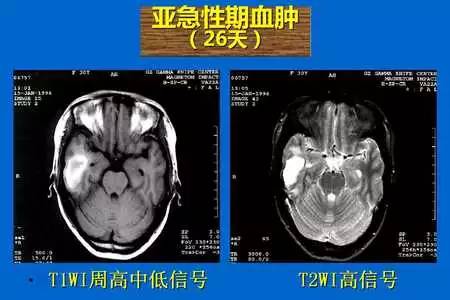 【PPT】脑出血的 CT/MRI