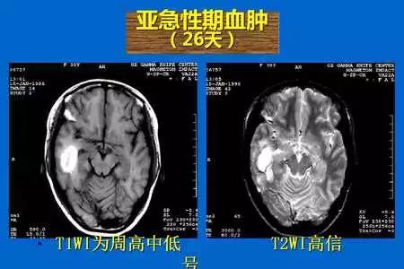 【PPT】脑出血的 CT/MRI