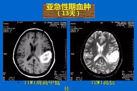 【PPT】脑出血的 CT/MRI
