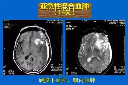 【PPT】脑出血的 CT/MRI