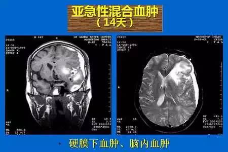 【PPT】脑出血的 CT/MRI
