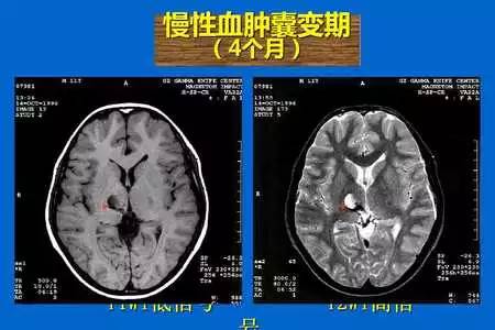 【PPT】脑出血的 CT/MRI