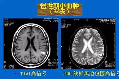 【PPT】脑出血的 CT/MRI