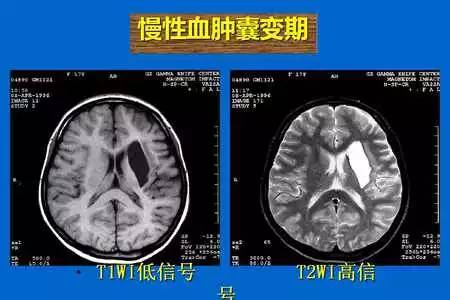【PPT】脑出血的 CT/MRI