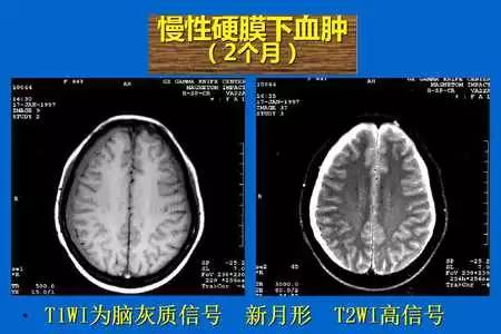 【PPT】脑出血的 CT/MRI