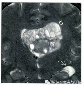 【双语病例】中枢神经细胞瘤1例MR影像表现与鉴别