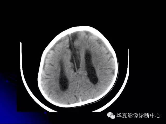 【PPT】颅脑先天发育畸形