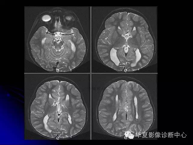 【PPT】颅脑先天发育畸形