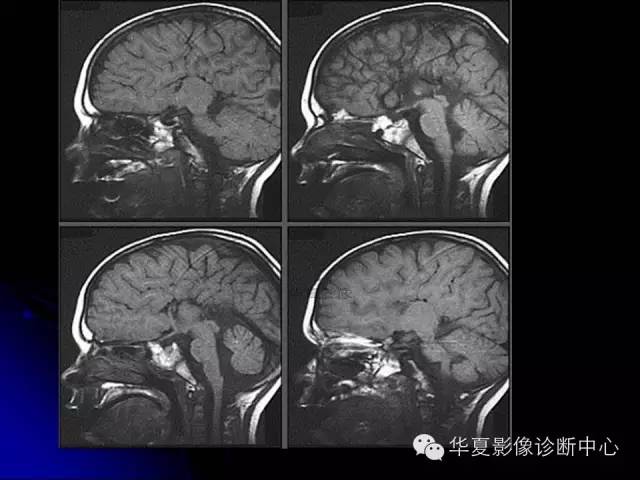 【PPT】颅脑先天发育畸形