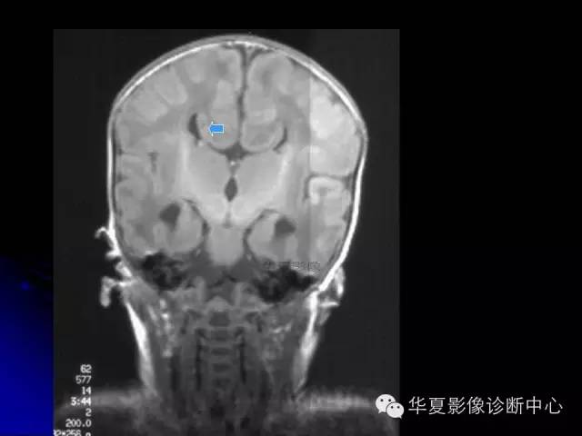 【PPT】颅脑先天发育畸形