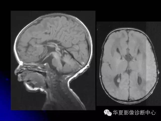 【PPT】颅脑先天发育畸形