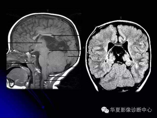 【PPT】颅脑先天发育畸形
