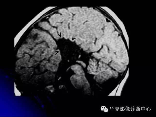 【PPT】颅脑先天发育畸形