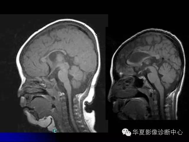 【PPT】颅脑先天发育畸形