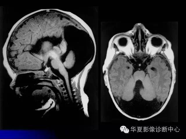 【PPT】颅脑先天发育畸形