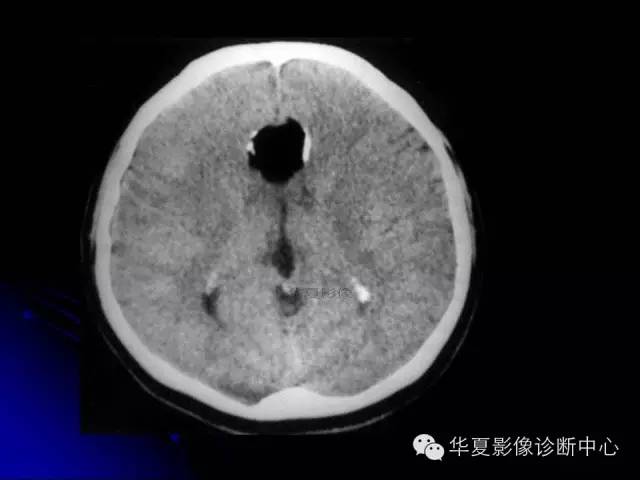 【PPT】颅脑先天发育畸形
