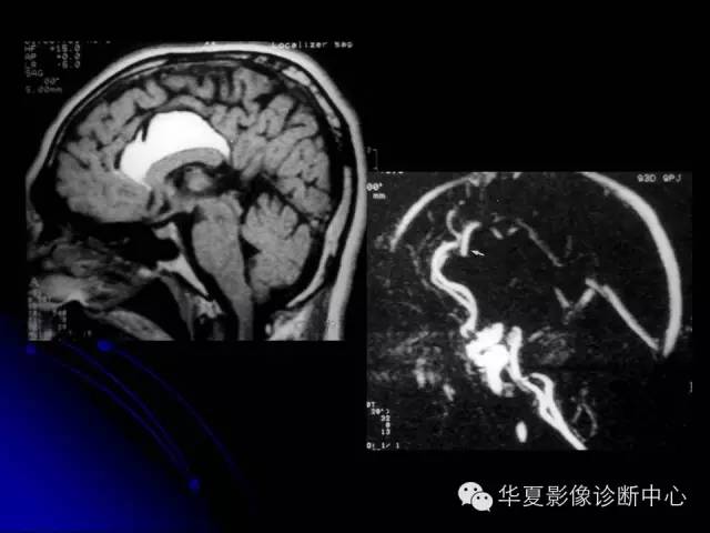 【PPT】颅脑先天发育畸形