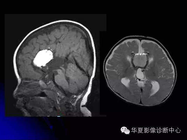 【PPT】颅脑先天发育畸形
