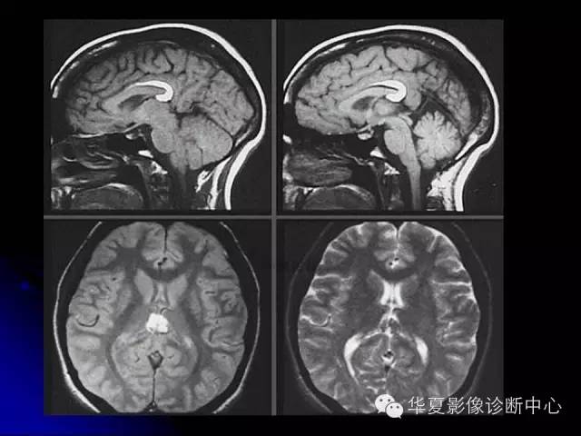 【PPT】颅脑先天发育畸形