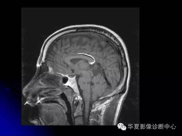 【PPT】颅脑先天发育畸形