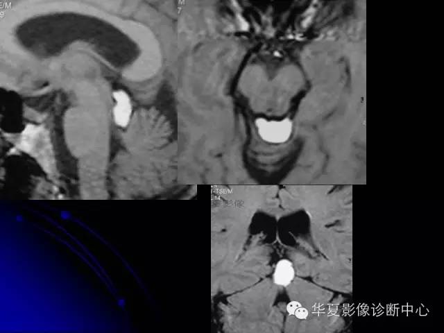 【PPT】颅脑先天发育畸形