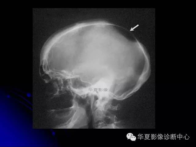 【PPT】颅脑先天发育畸形