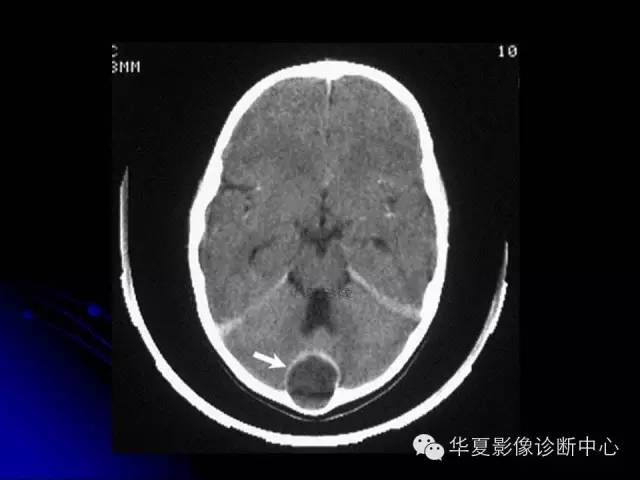 【PPT】颅脑先天发育畸形