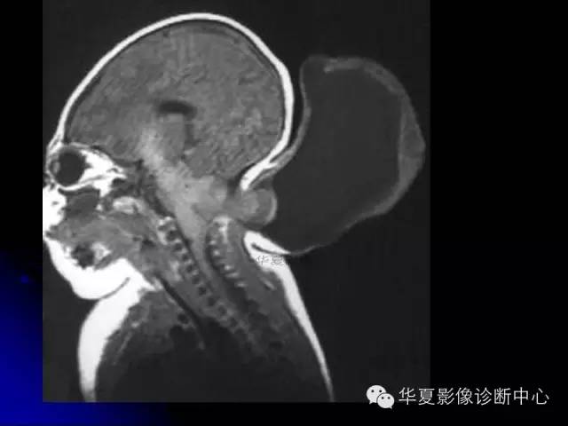 【PPT】颅脑先天发育畸形