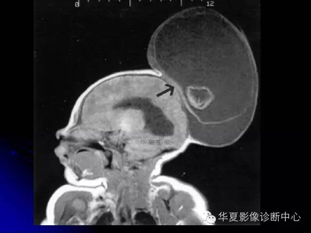 【PPT】颅脑先天发育畸形