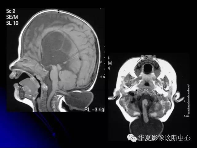 【PPT】颅脑先天发育畸形