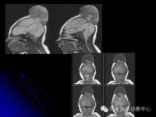 【PPT】颅脑先天发育畸形