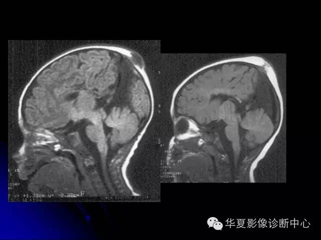 【PPT】颅脑先天发育畸形