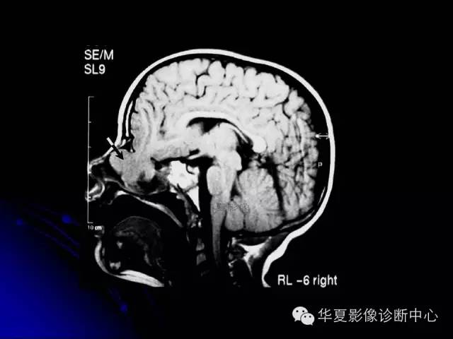 【PPT】颅脑先天发育畸形