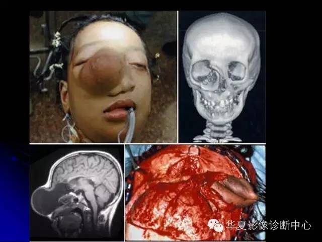 【PPT】颅脑先天发育畸形